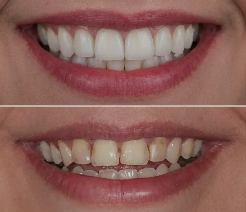 Before and after cosmetic dentistry smile at Dental Elements in Shawnee, Leawood and Wellsville, KS