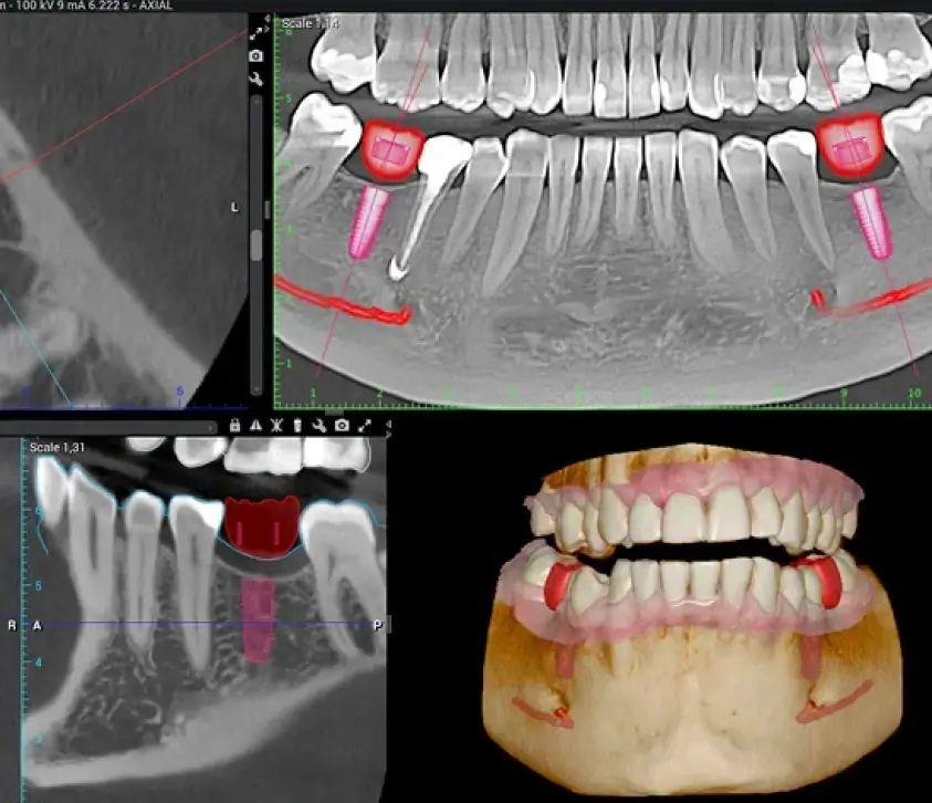 Dental implant X-ray and model at Dental Elements in Shawnee, Leawood and Wellsville, KS